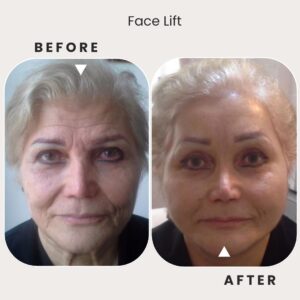 Face Lift